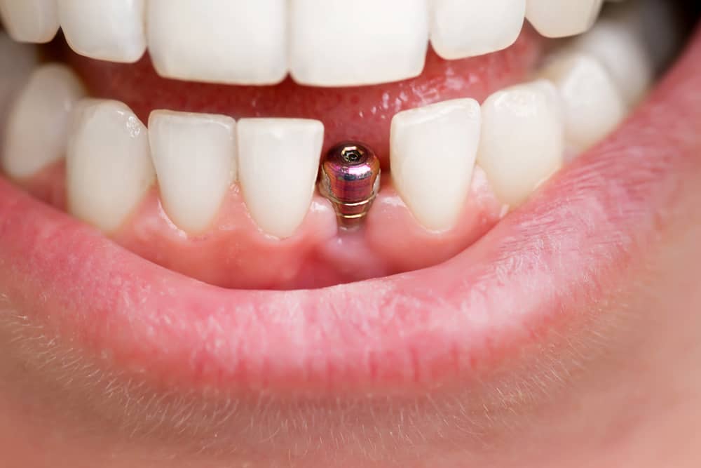 The Tooth Replacement Guide: All You Need to Know About Dental Implants